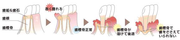 歯周病の進行